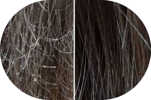 img-treatmentdryhair